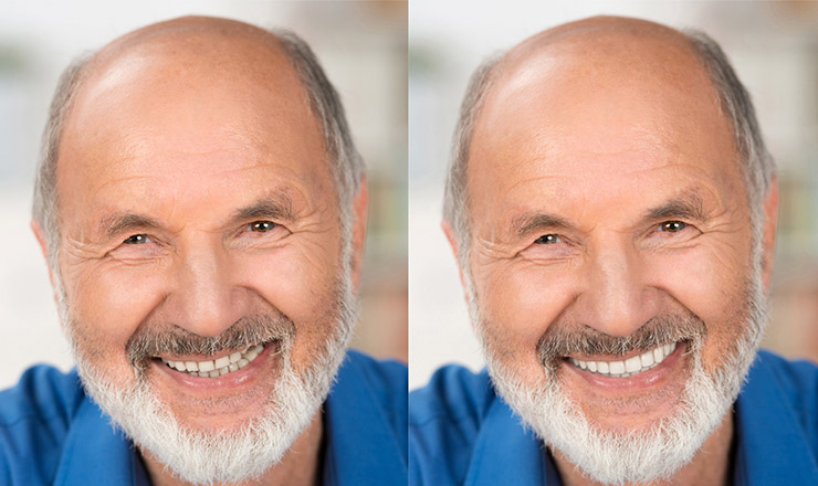 Smile-Vision | Before & After