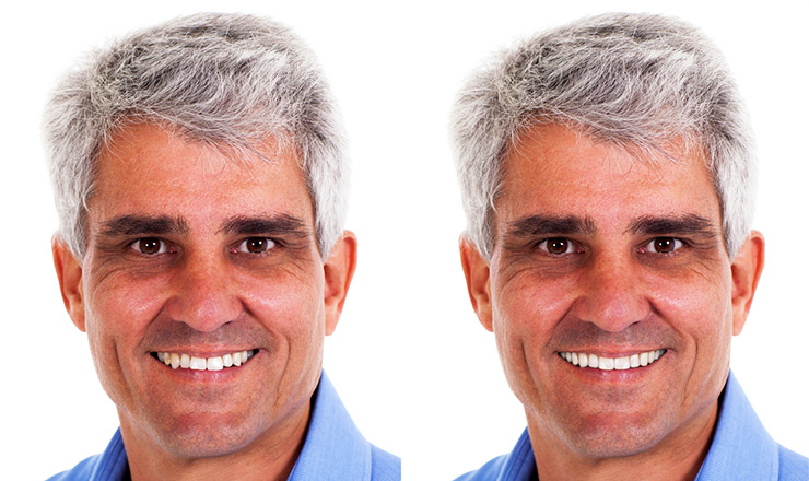 Smile-Vision | Before & After