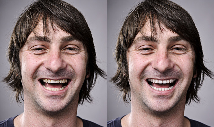 Smile-Vision | Before & After