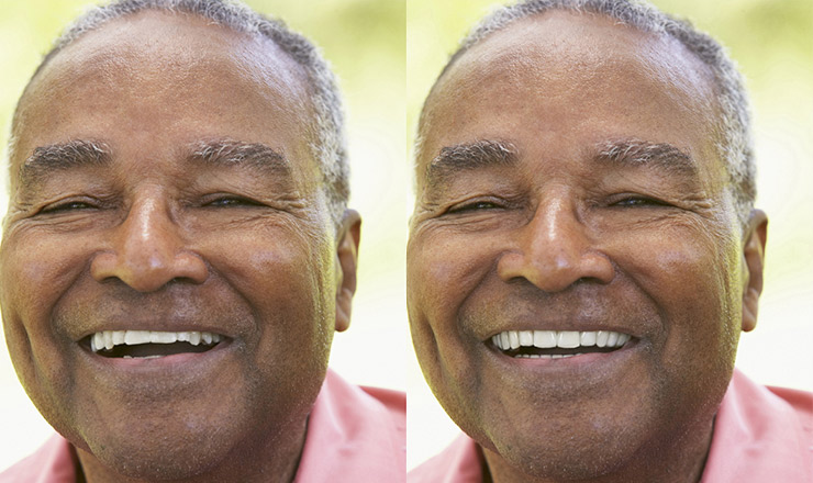 Smile-Vision | Before & After