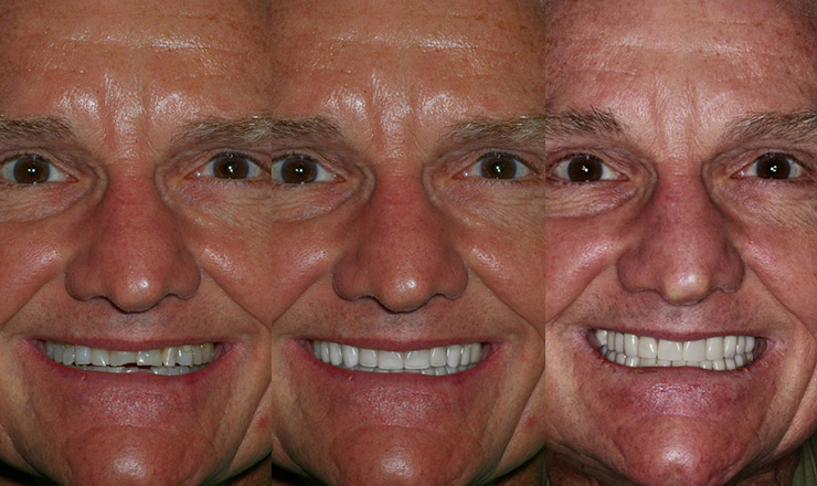 Smile-Vision | Before & After